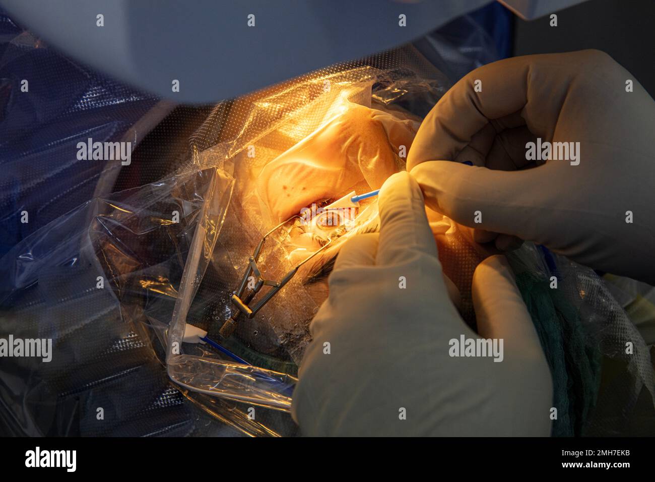 Eye surgery process, treatment of cataract and diopter correction