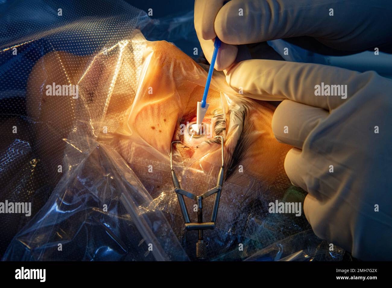 Eye surgery process, treatment of cataract and diopter correction