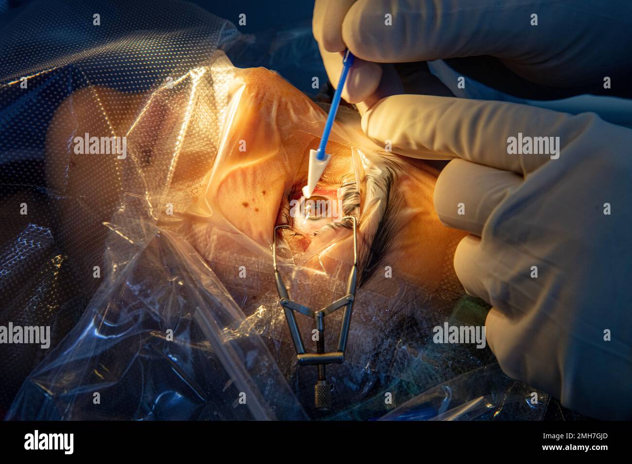 Eye surgery process, treatment of cataract and diopter correction