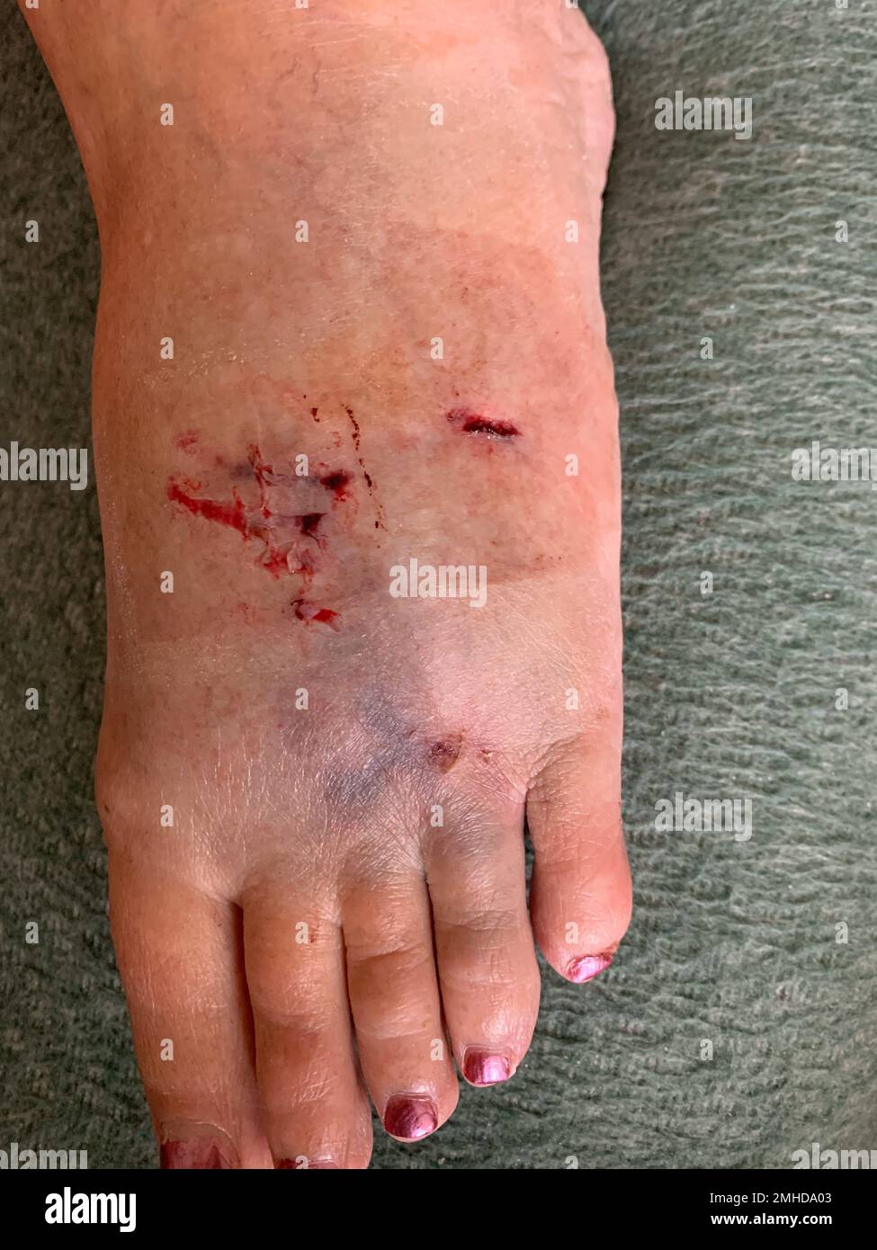 A woman's foot bitten by a dog Stock Photo