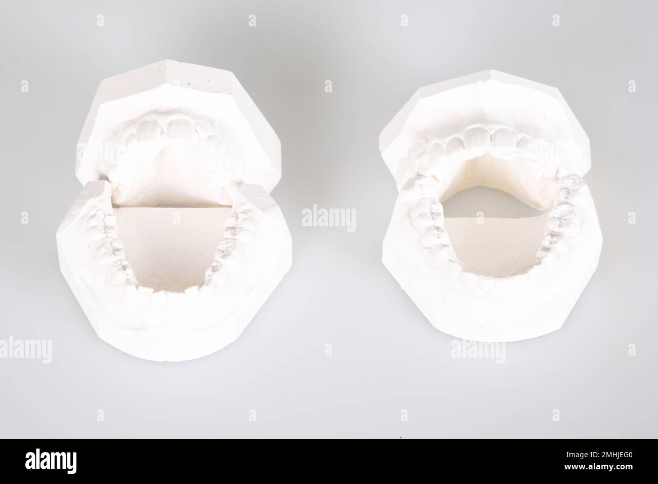 Denture dental implants gypsum print white plaster teeth in dental