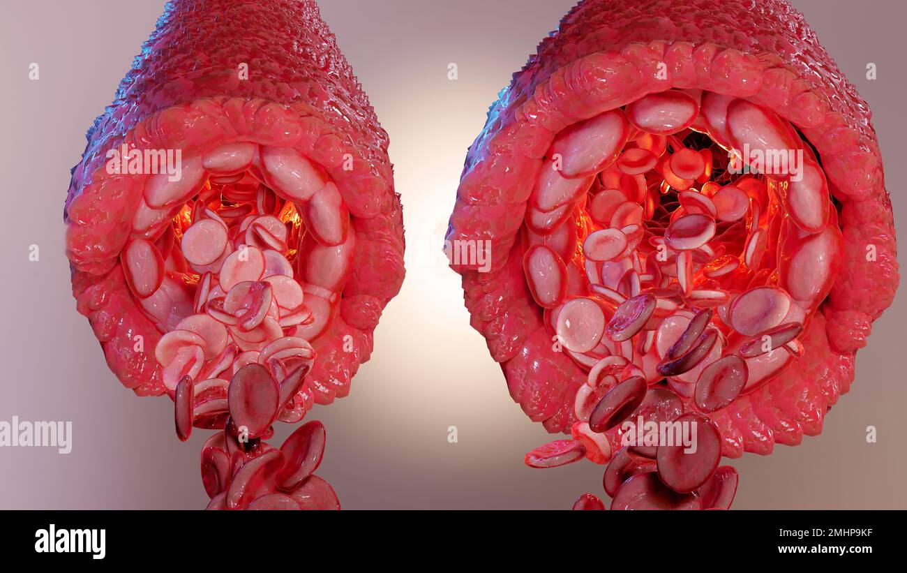 vasoconstriction and vasodilation blood pressure, dilated blood vessels or capillaries or artery, Increase and decrease in blood flow through the blo Stock Photo