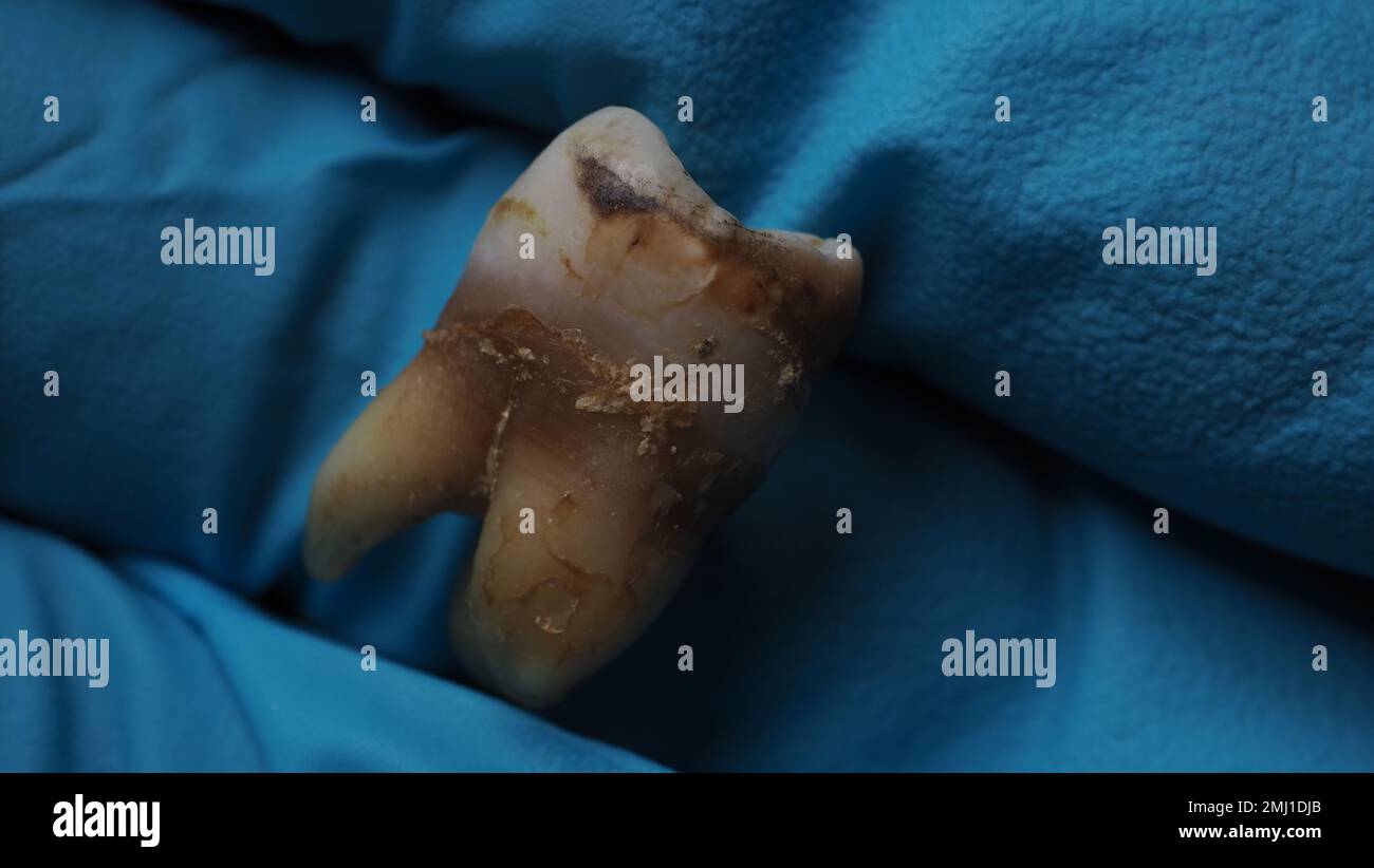 One Tooth Decayed Tooth decay and dentist hand with glove and black background. Macro ...