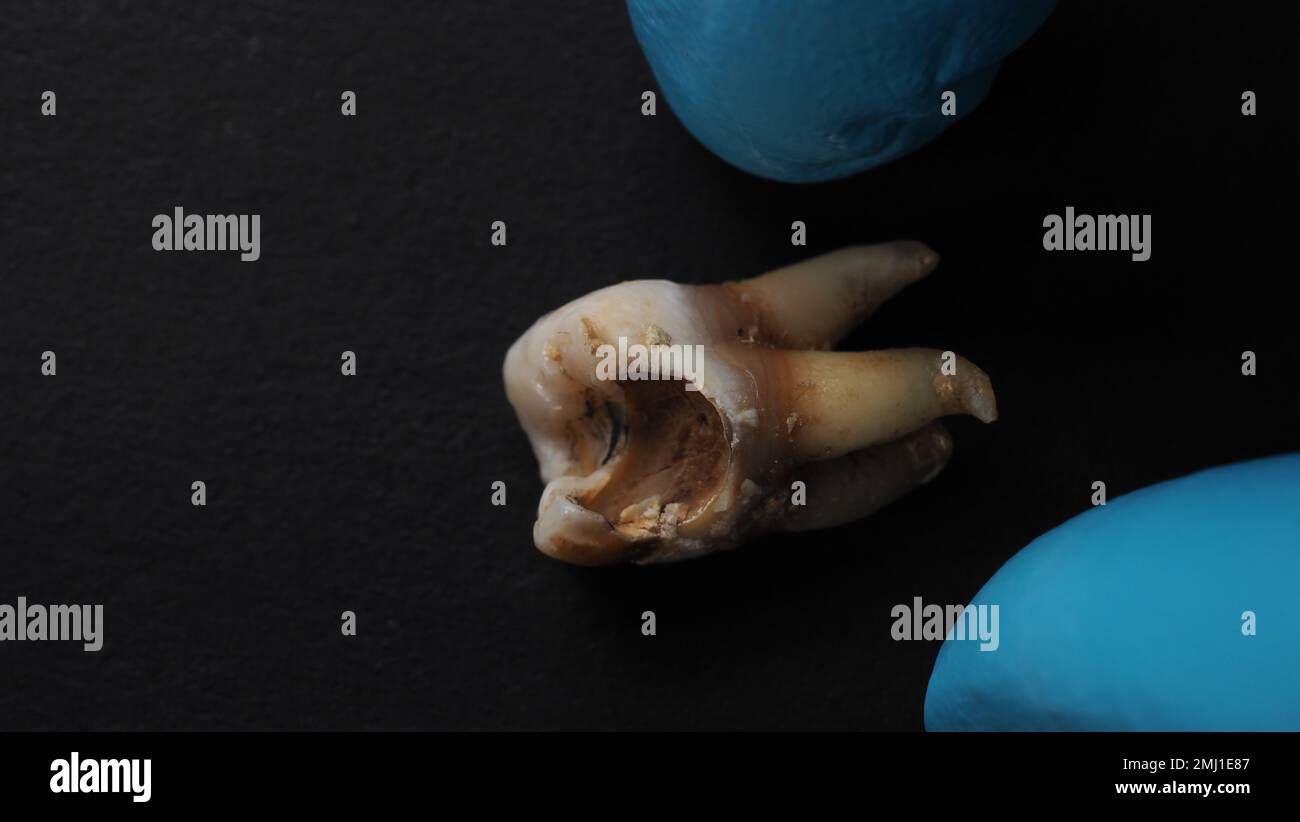 One Tooth Decayed Tooth decay and dentist hand with glove and black background. Macro ...