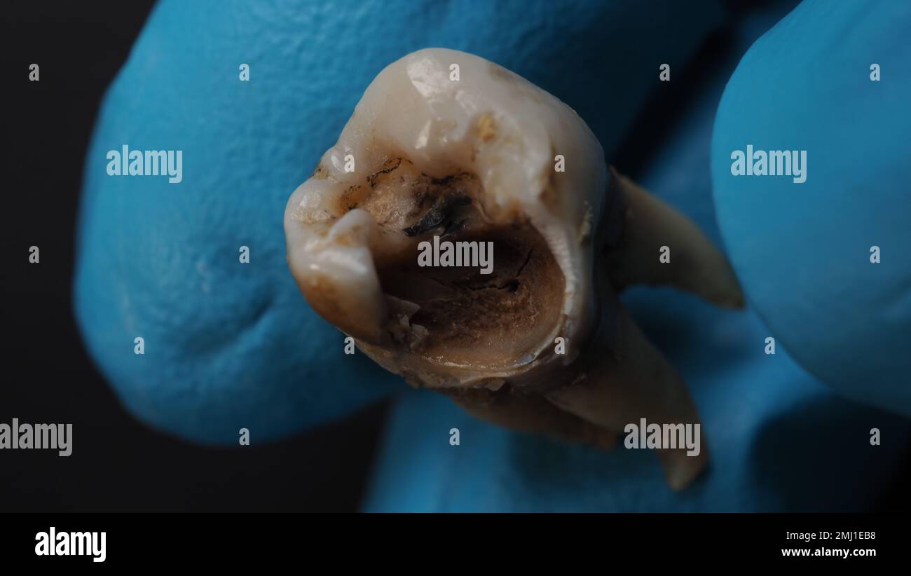 Tooth decay and dentist hand with glove and black background. Macro ...