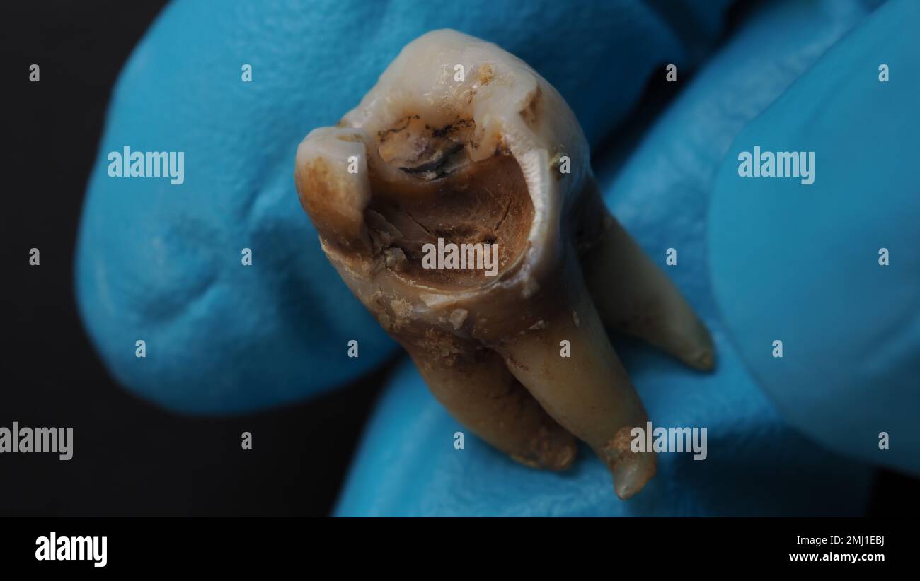 One Tooth Decayed Tooth decay and dentist hand with glove and black background. Macro ...