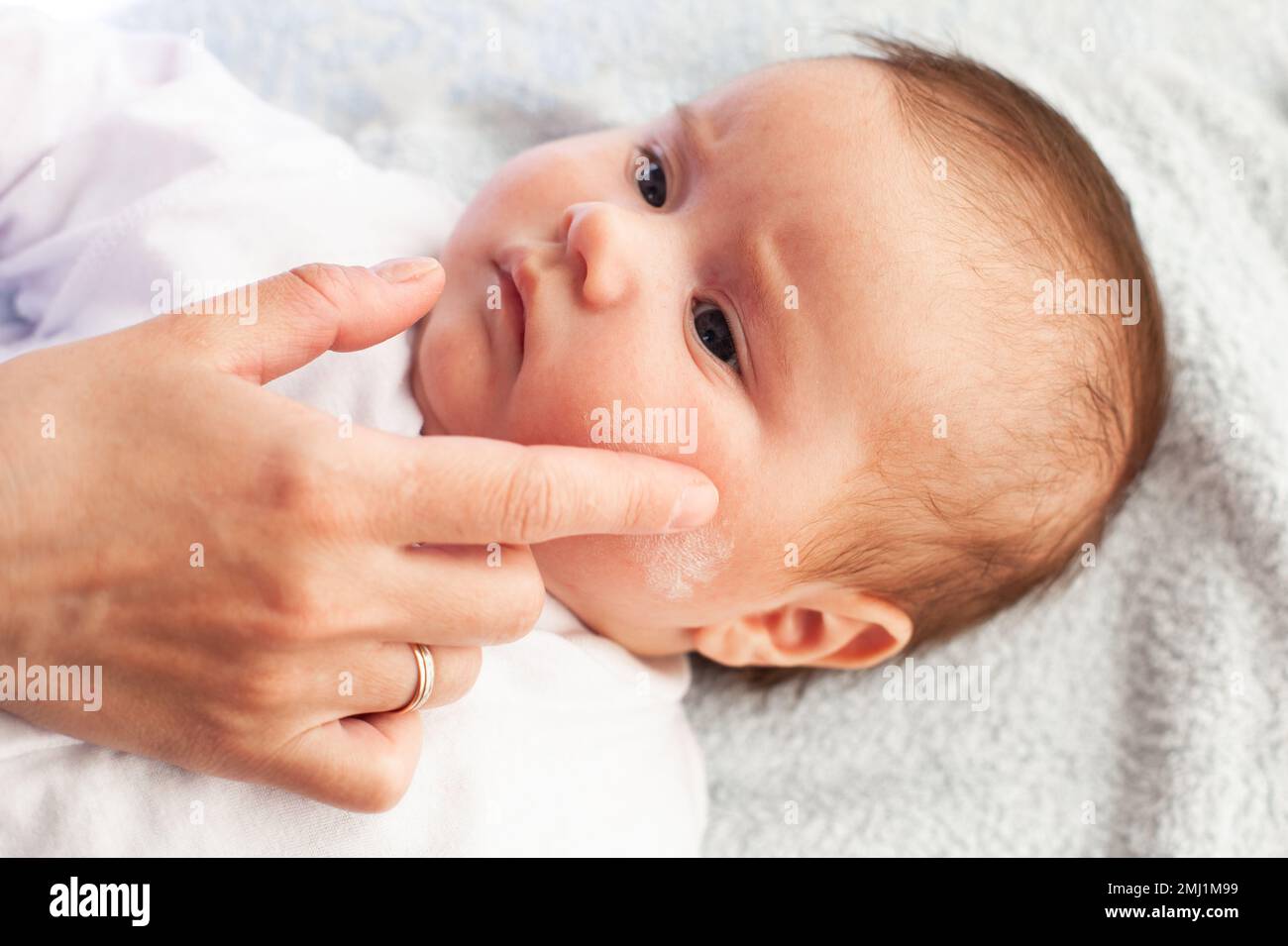 Baby with atopic dermatitis getting cream put. Care and Prevention Of