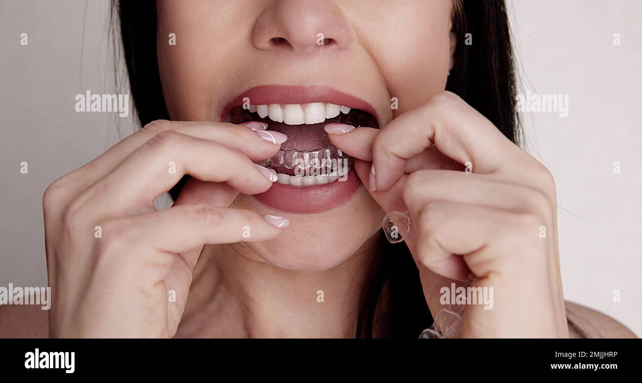 Clear Dental Aligner And Orthodontic Night Guard Stock Photo Alamy