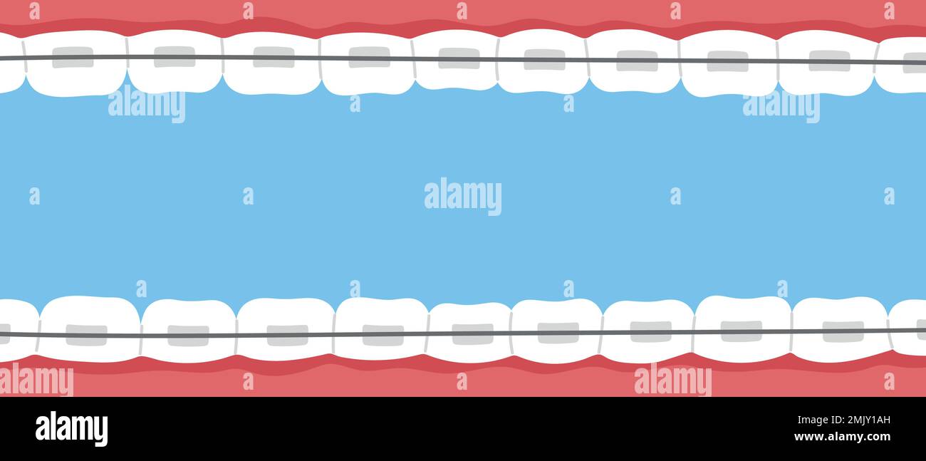 Teeth braces banner. Orthodontic problem, smile with brackets, retainer