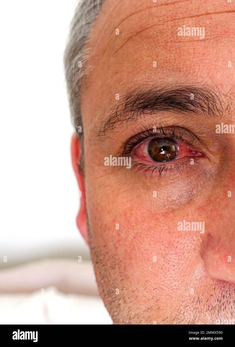 eye bleeding, conjunctivitis disease, conjunctivitis in the eye Stock