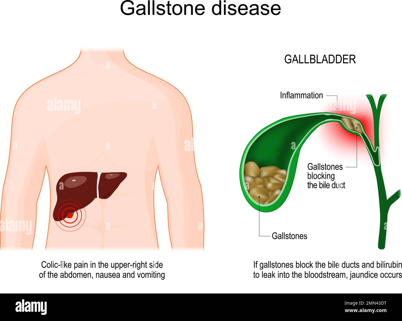 gallstone disease. Human body with liver. Cross section of Gallbladder with Gallstones that blocking of a bile duct. Symptoms of cholelithiasis Stock Vector