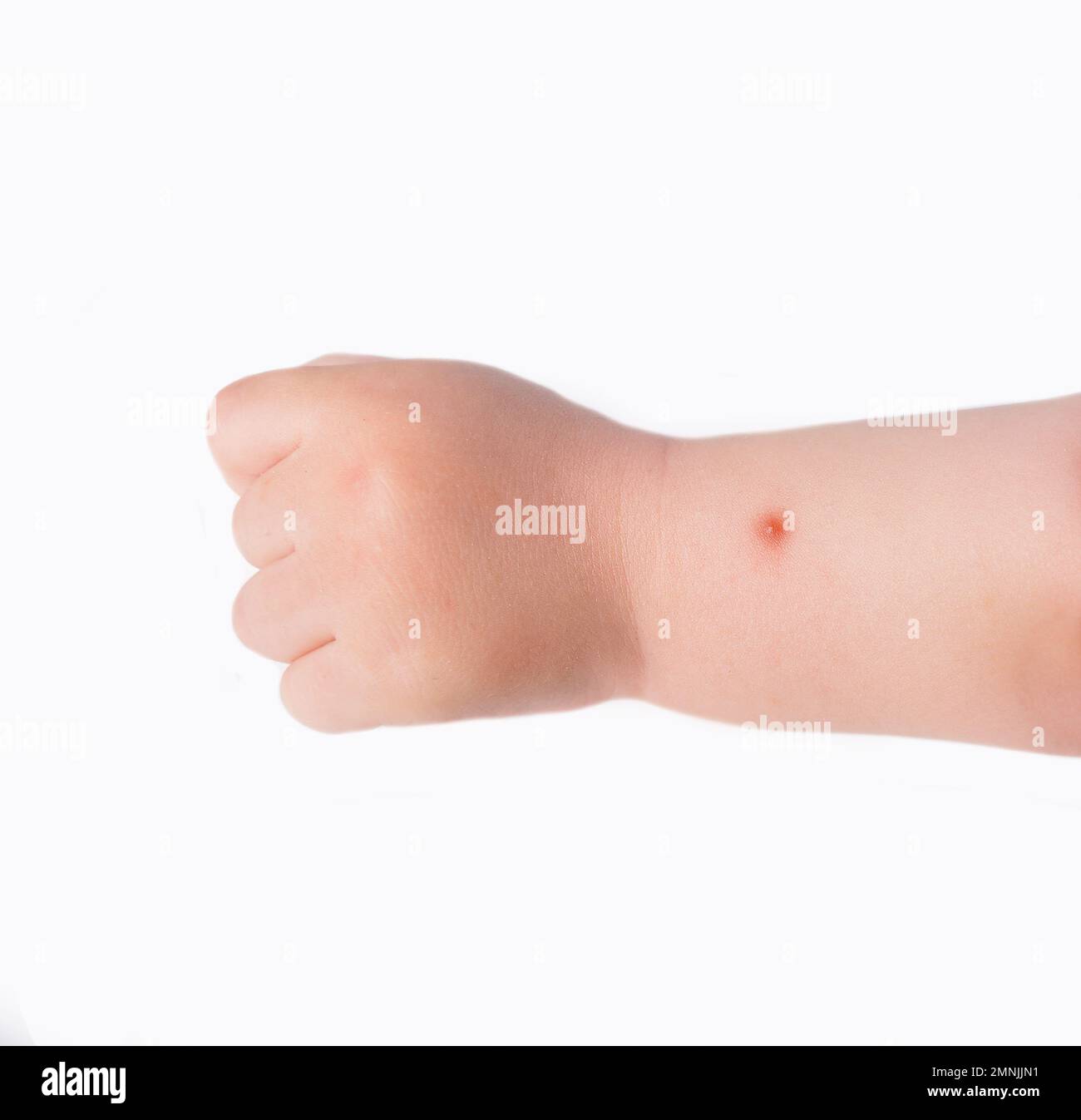 Mosquito bites sore and scar on child arm Stock Photo Alamy
