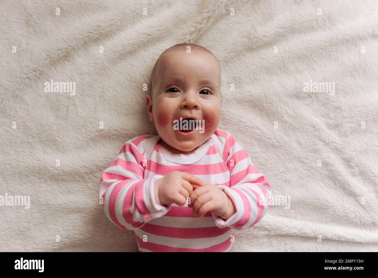 Portrait of cute baby girl with eczema on face Stock Photo Alamy