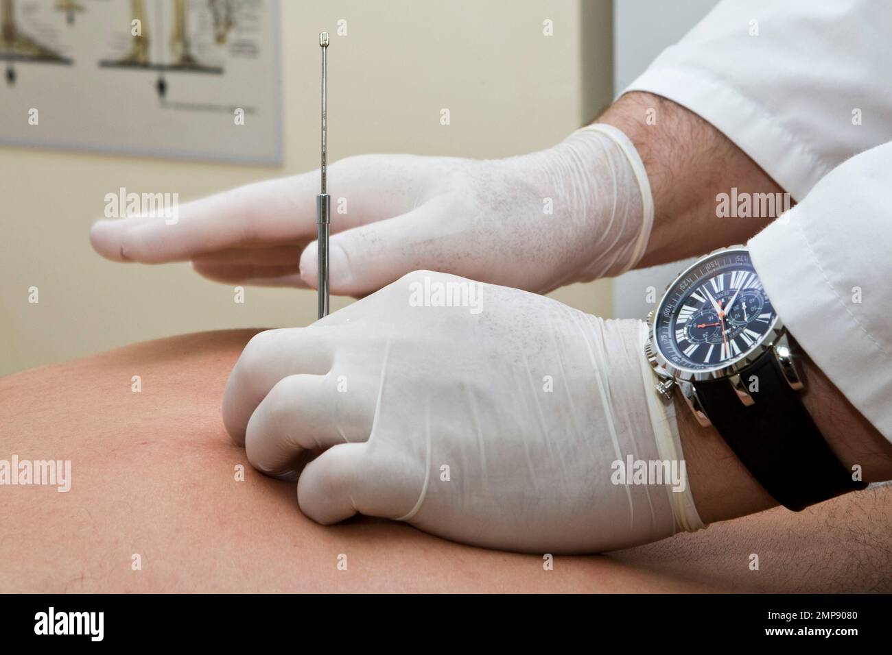 Acupuncture, needle therapy, acupuncture needles Stock Photo Alamy