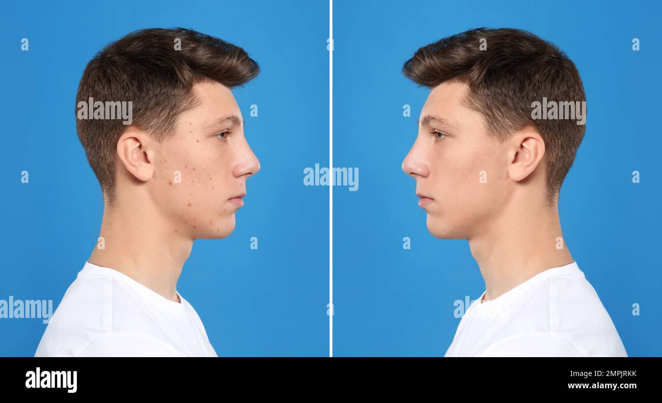 Teenager before and after acne treatment on blue background Stock Photo ...
