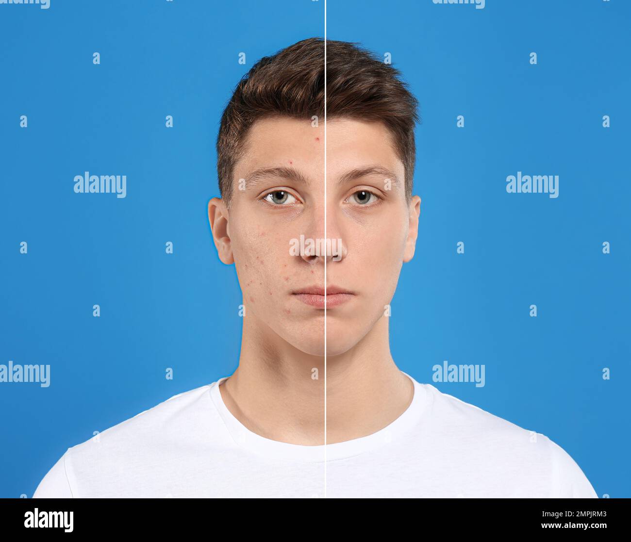 Teenager before and after acne treatment on blue background Stock Photo ...