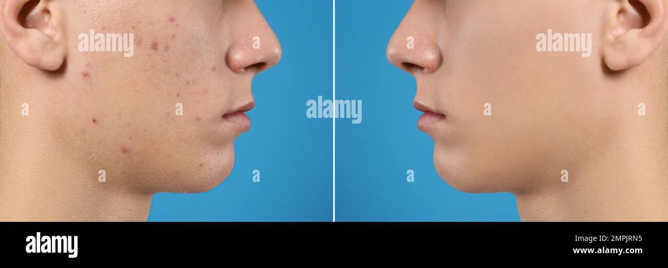 Teenager before and after acne treatment on blue background, closeup ...