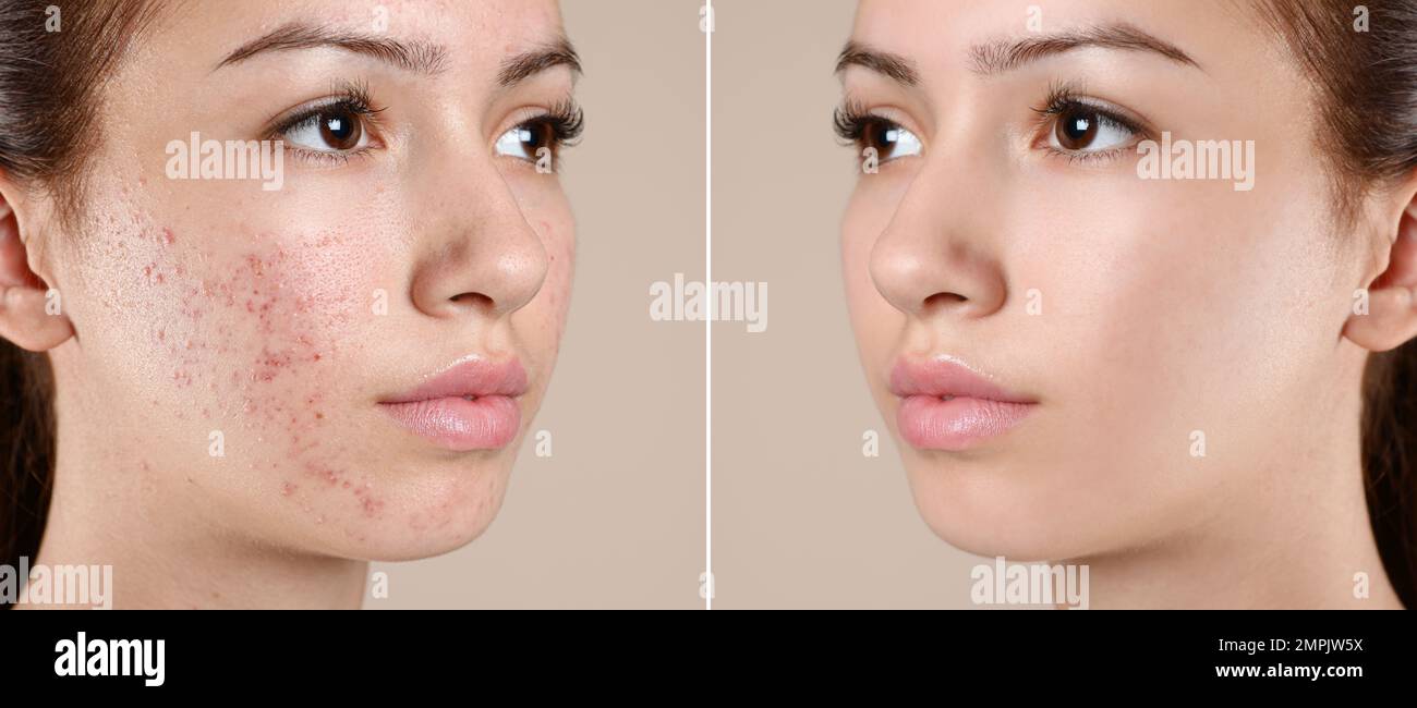 Teenage girl before and after acne treatment on beige background Stock ...