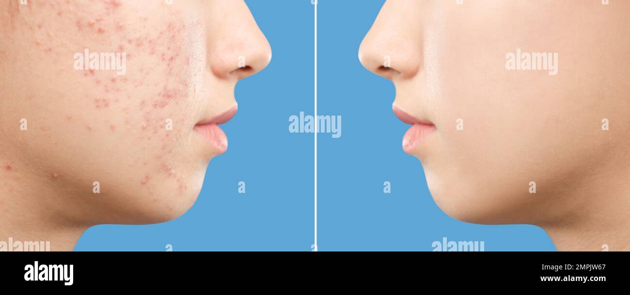 Teenage girl before and after acne treatment on blue background ...