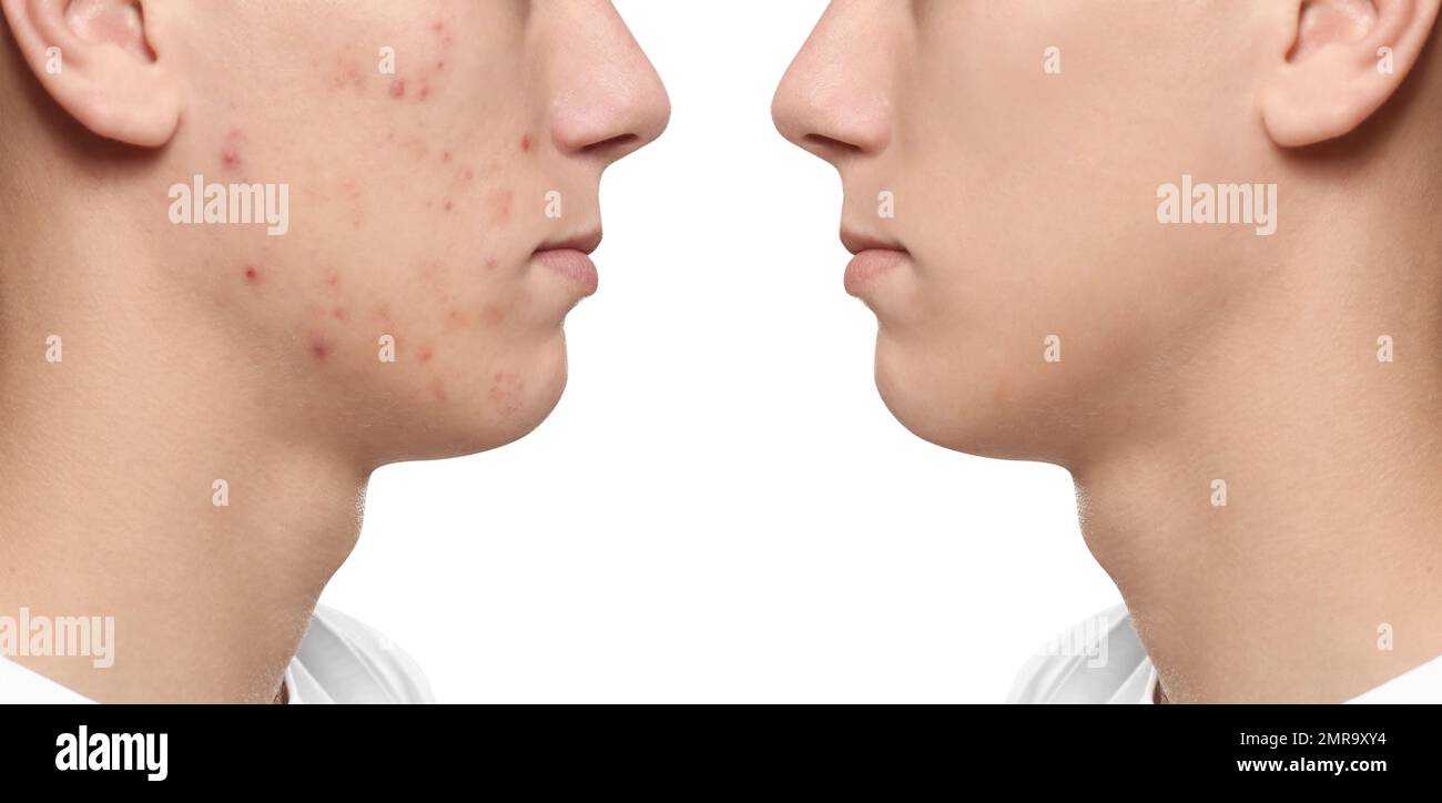 Teenager before and after acne treatment on white background, closeup ...
