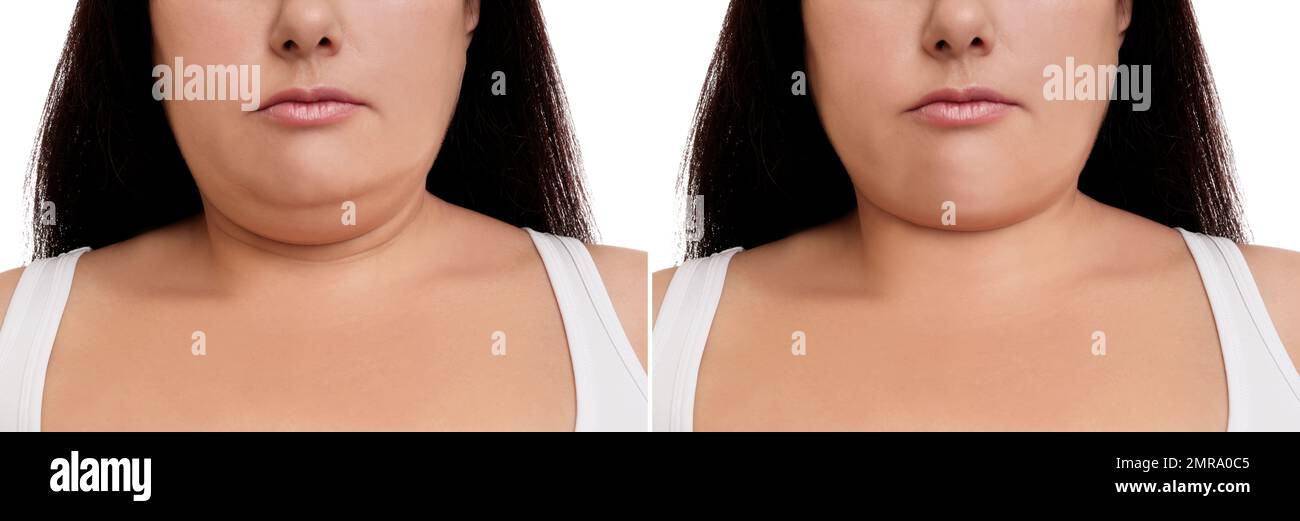 Woman before and after plastic surgery operation on white background, closeup. Double chin problem Stock Photo