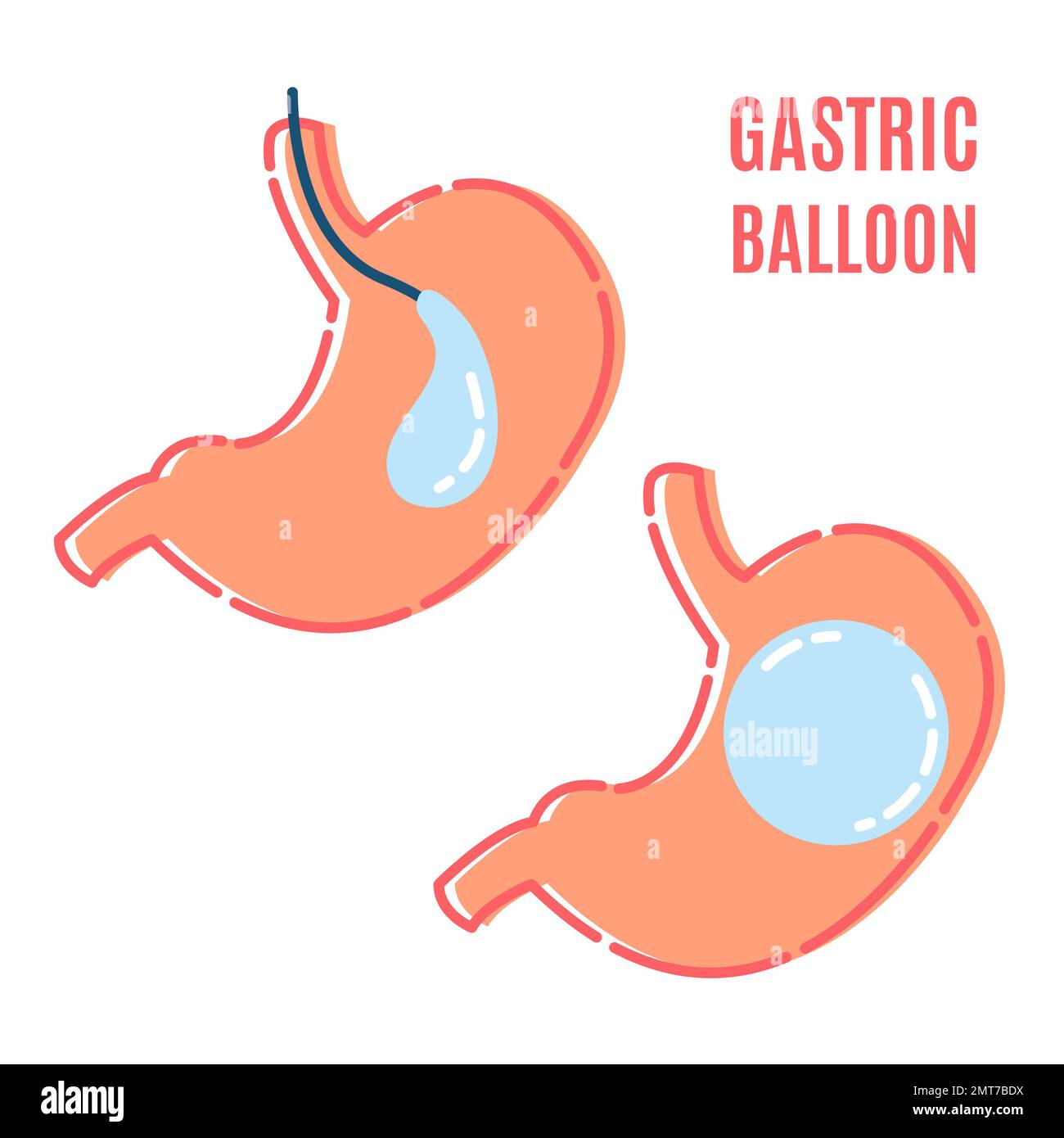 Gastric Balloon Weight Loss Procedure Shown In Stomach Stock Vector Image And Art Alamy