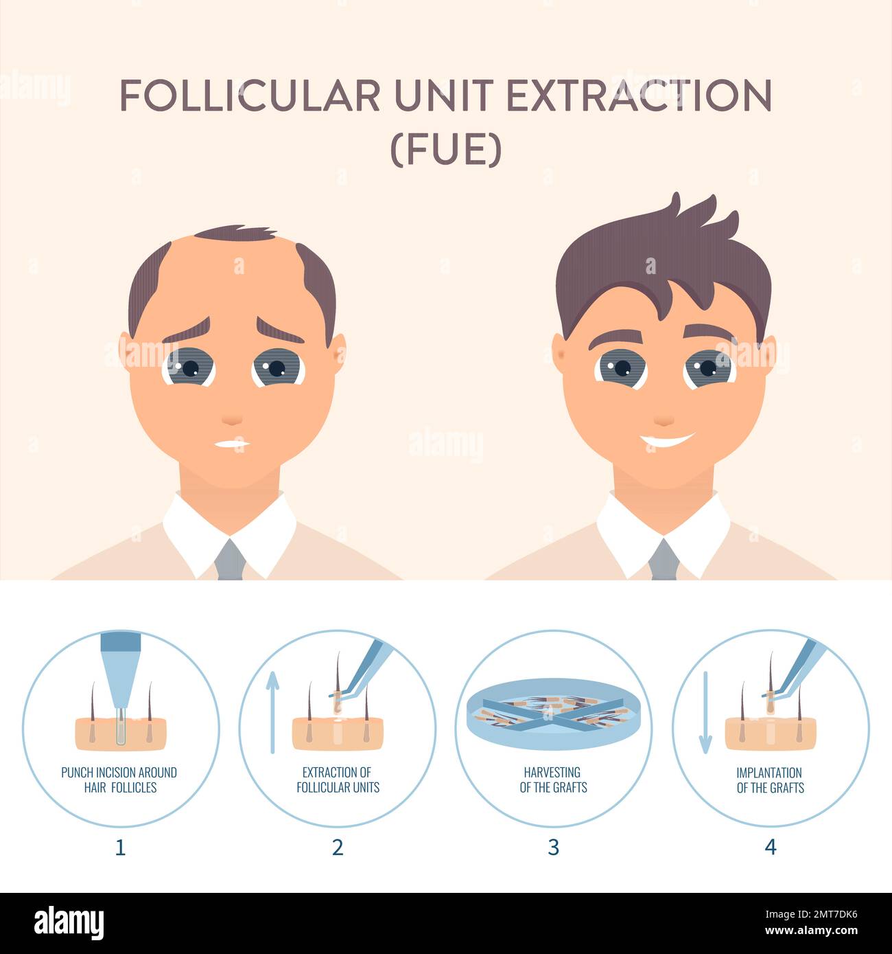 Hair transplantation procedure in men medical infographic poster Stock Vector