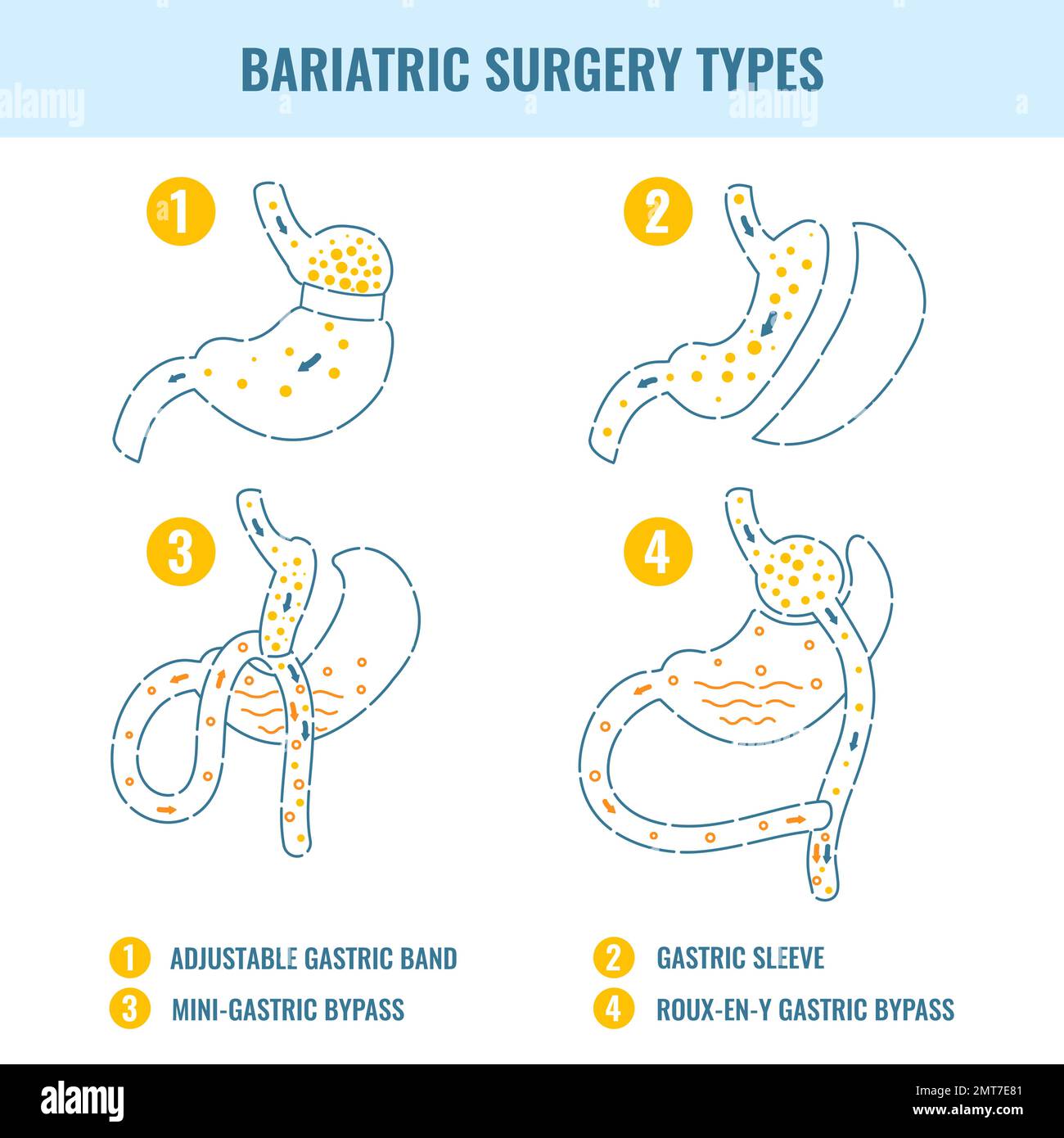 Laparoscopy procedure Stock Vector Images - Alamy