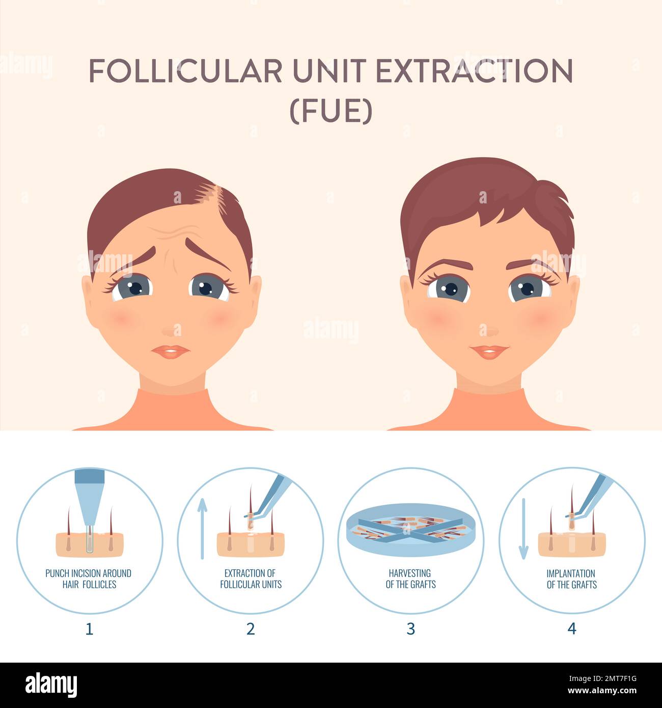 Female hair transplantation procedure medical infographic poster Stock Vector