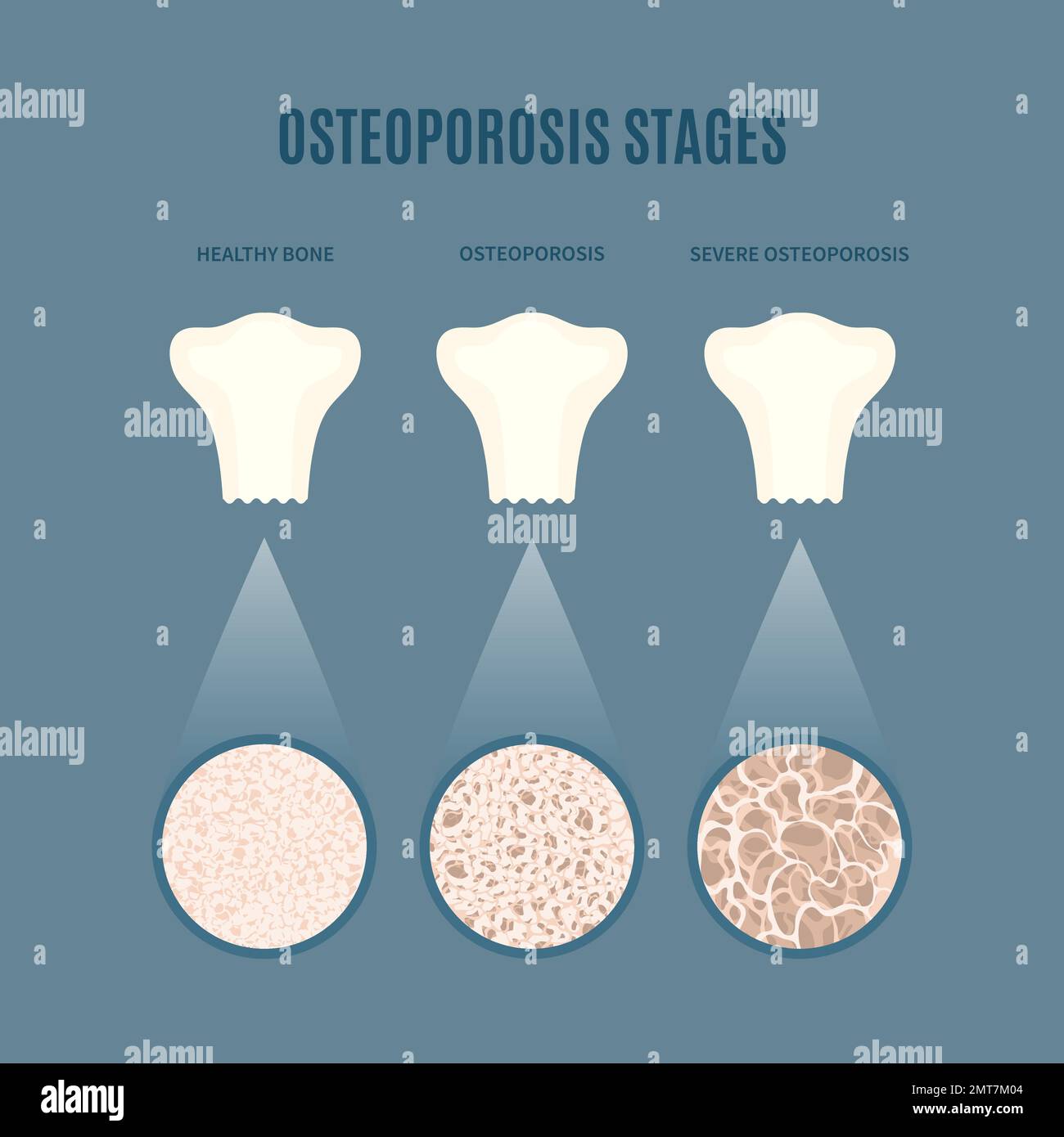 Osteoporosis bone density loss disease medical infographics Stock Vector