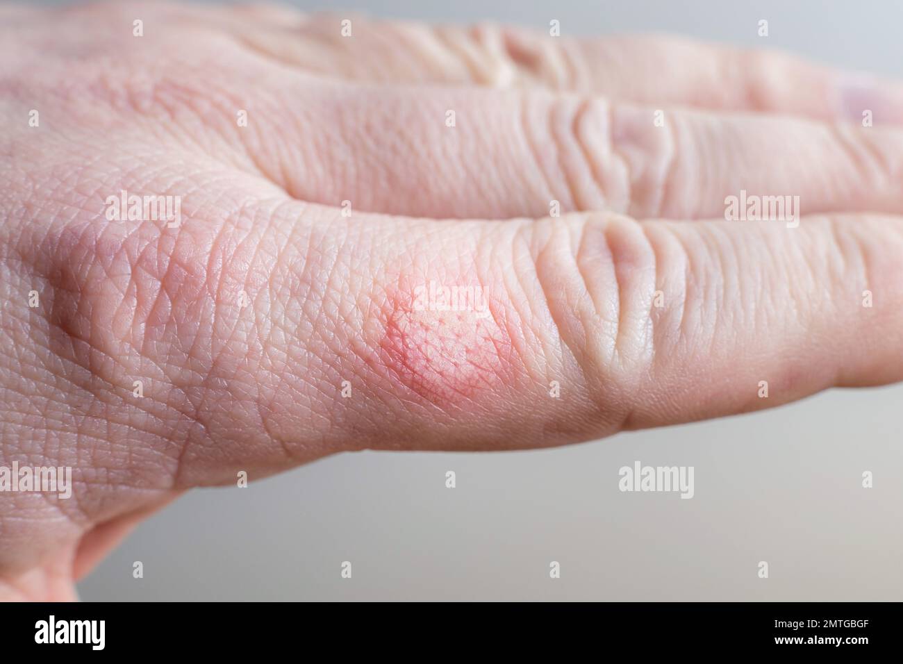 Burned skin on a finger of Caucasians man hand - red burned skin patch Stock Photo