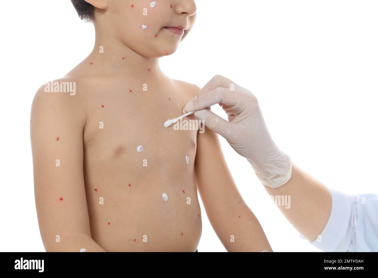 Chickenpox Doctor Doctor applying cream onto skin of little boy with chickenpox against ...