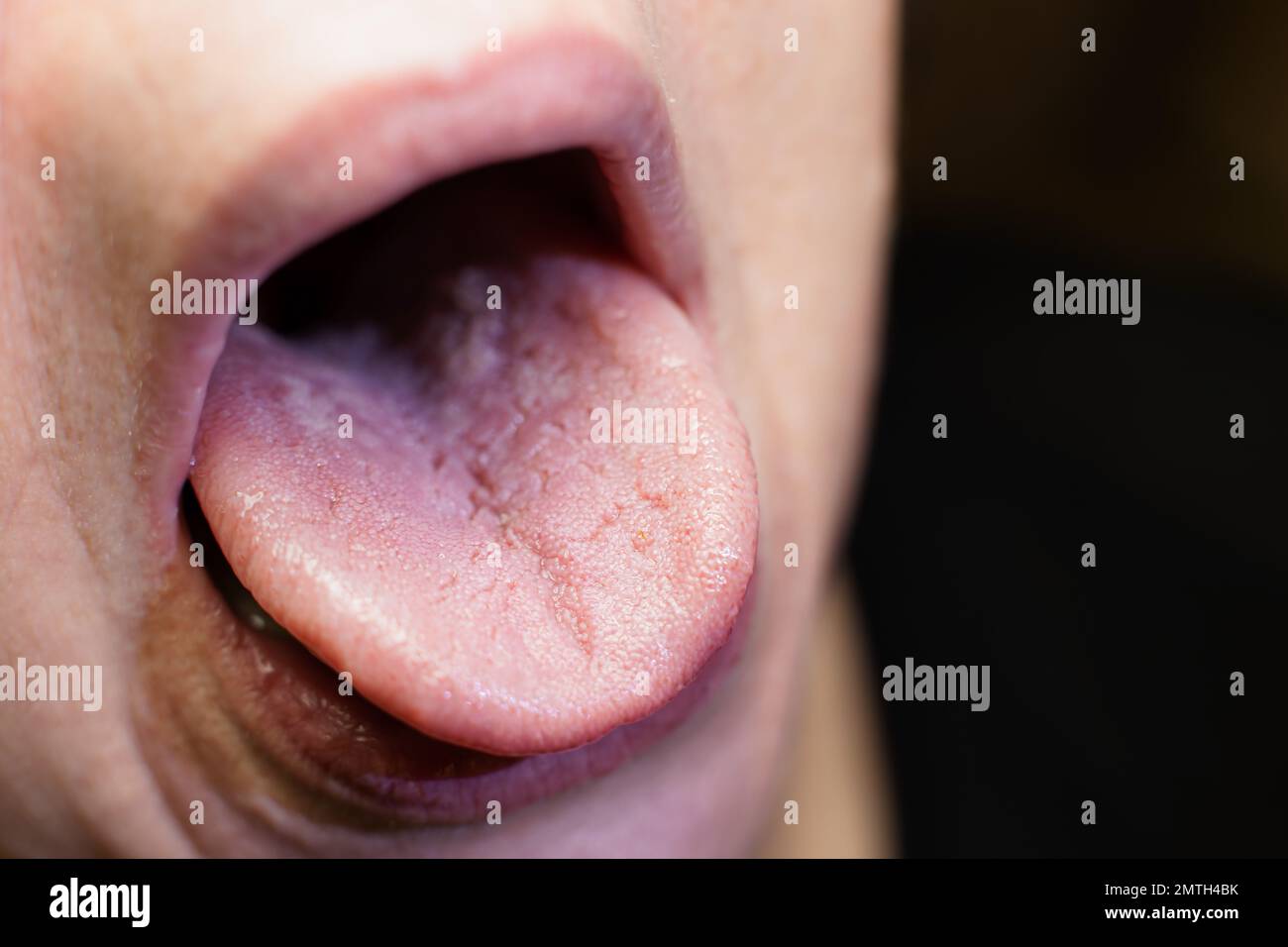 Male shows overgrowth candidiasis on his tongue - Shallow focus Stock Photo