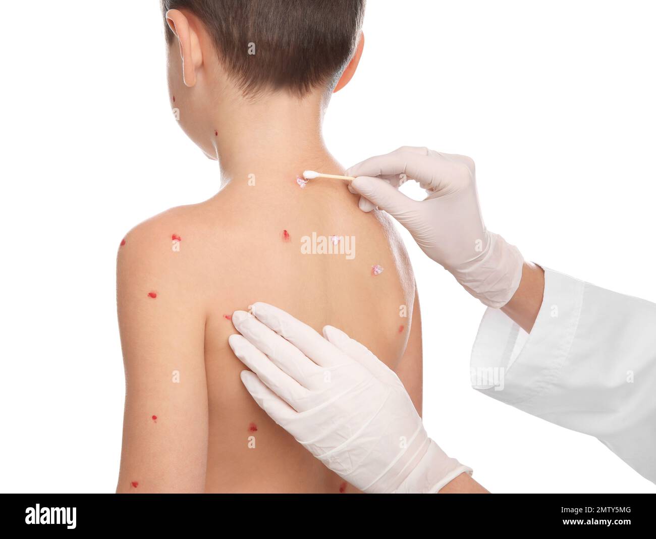 gabapentin cream for herpes zoster