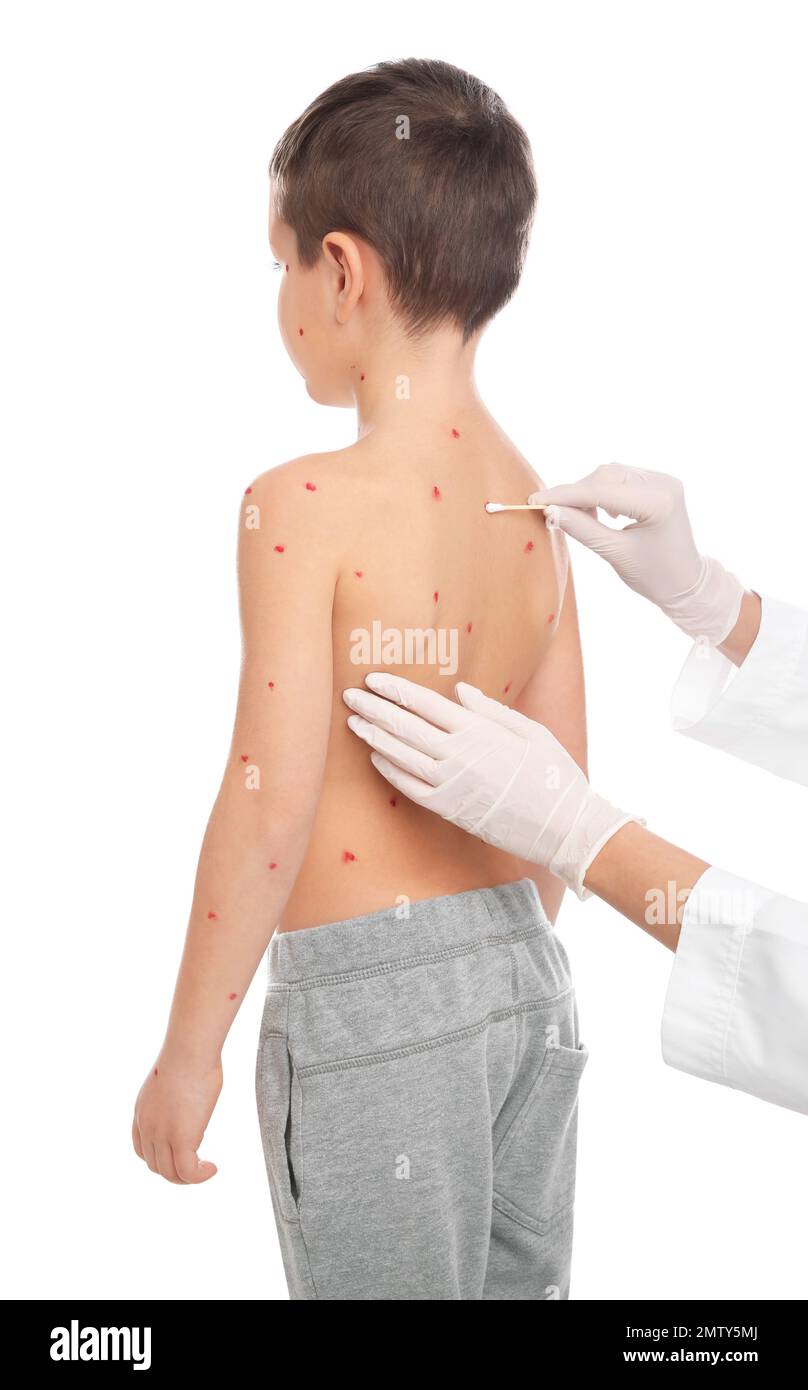 Chickenpox Doctor Doctor applying cream onto skin of little boy with chickenpox on white ...