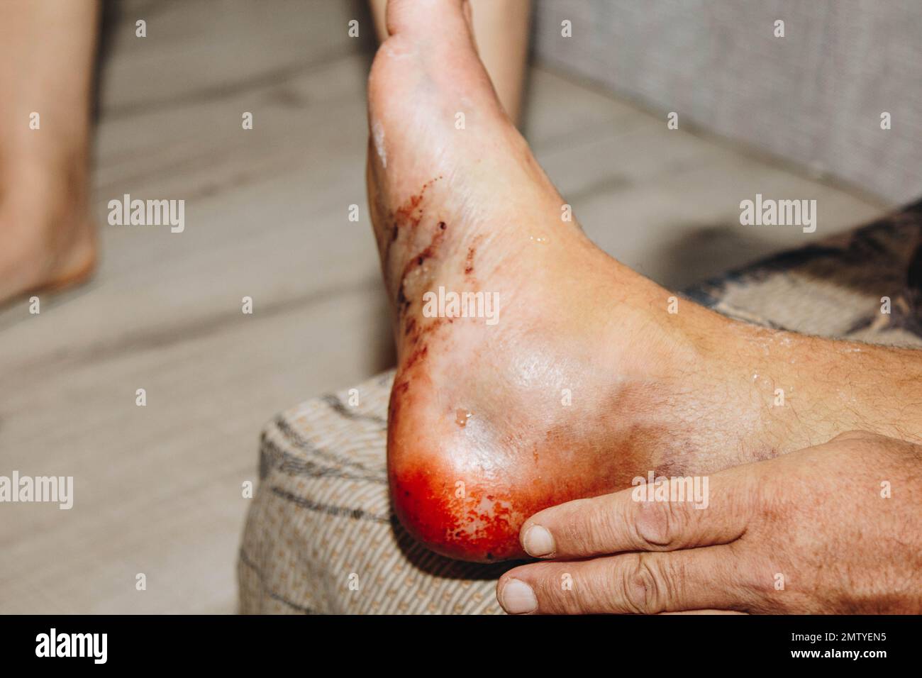 The process of treating a leg injury at home. Scar after surgery. Bone replacement. Titanium foot Stock Photo