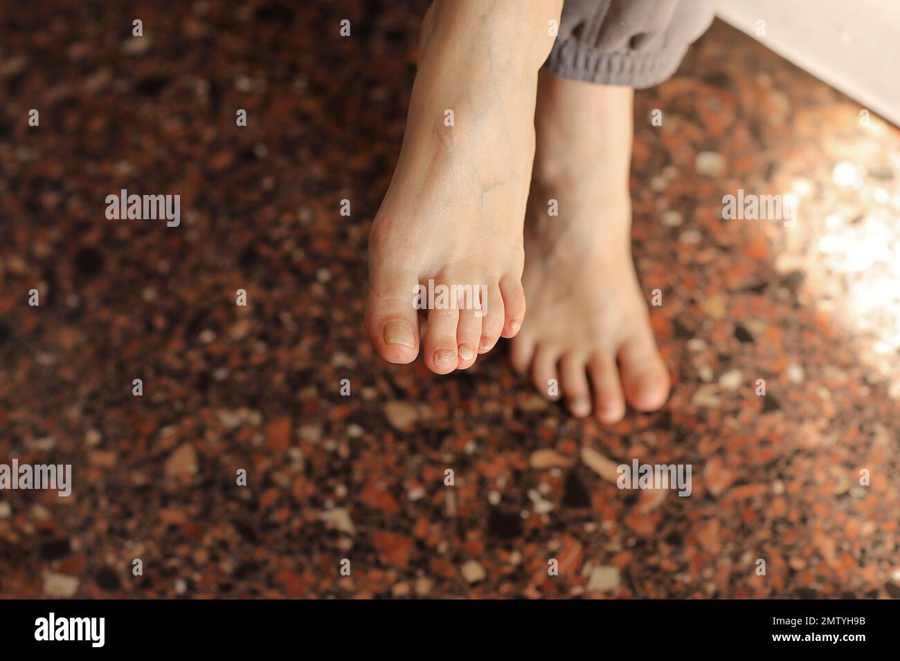 Female feet with subungual hematoma, black toenails caused by trauma