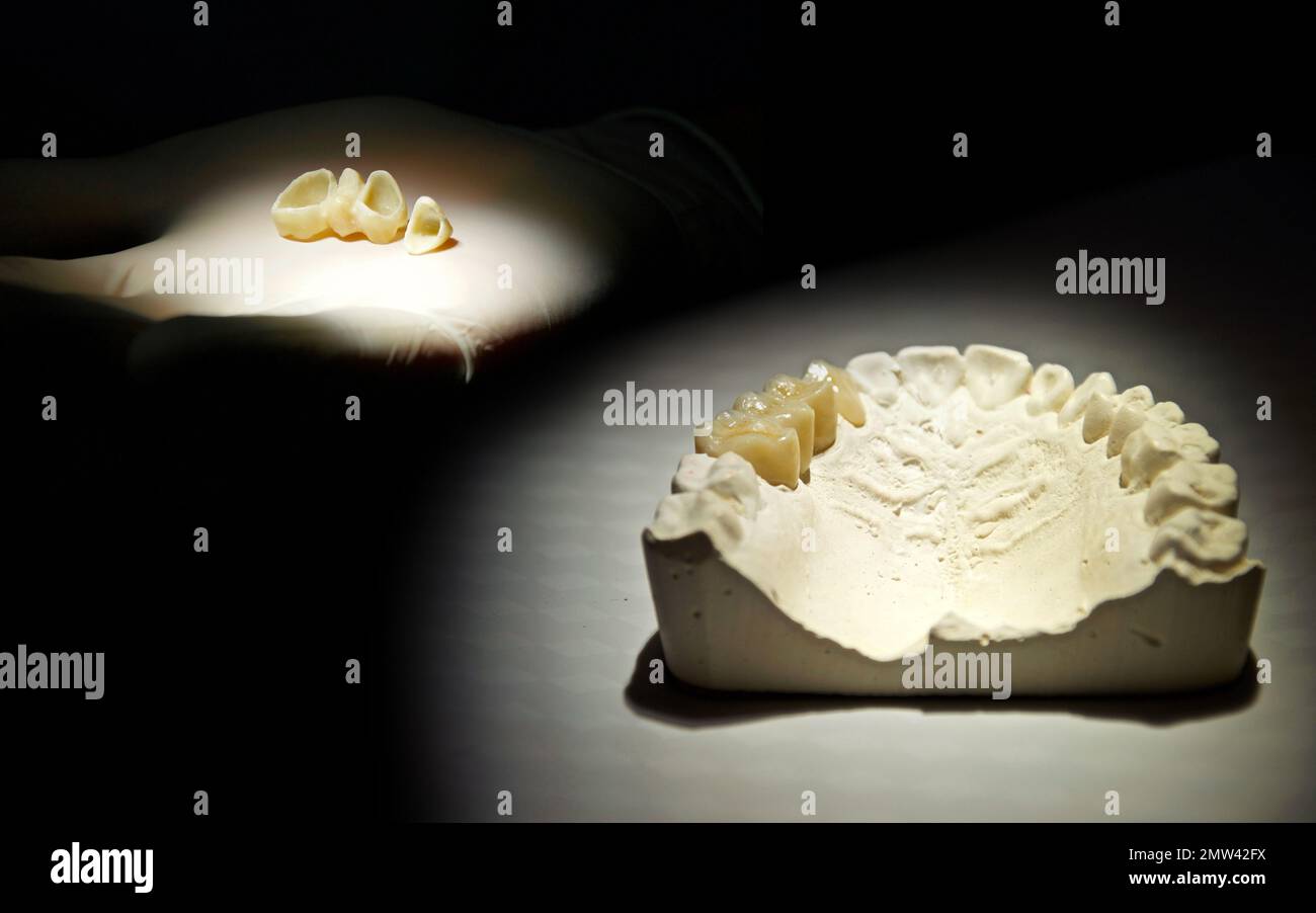 Dental bridge, acrylic resin teeth prosthesis implant on dentist hand