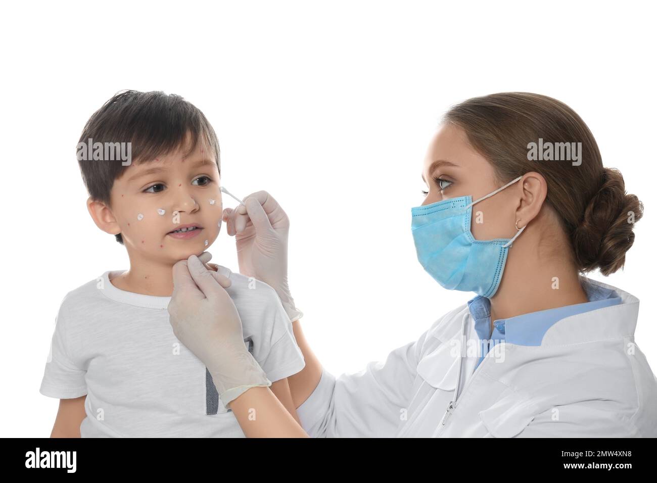 Chickenpox Doctor Doctor applying cream onto skin of little boy with chickenpox against ...