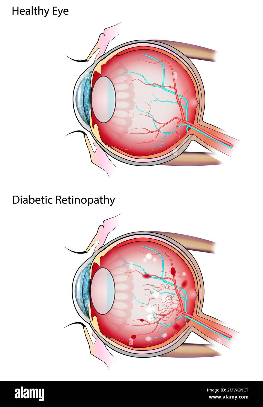 Healthy eye and diabetic retinopathy, illustration Stock Photo - Alamy
