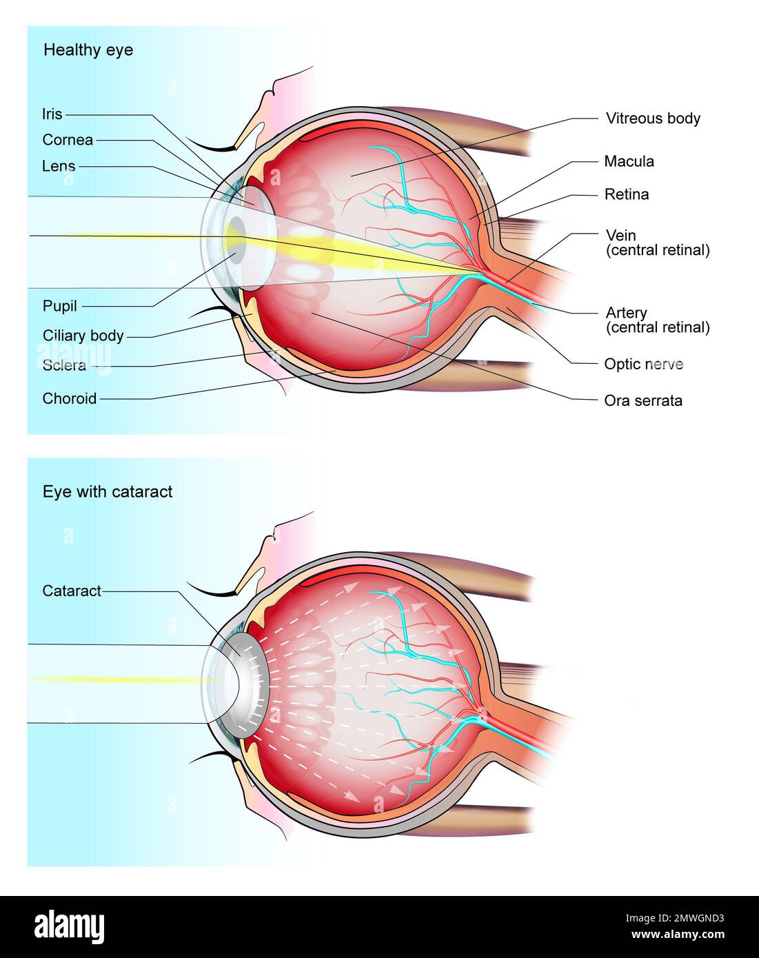 Normal Eye And Eye With Cataract Illustration Stock Photo Alamy Normal eye and eye with cataract illustration stock photo alamy