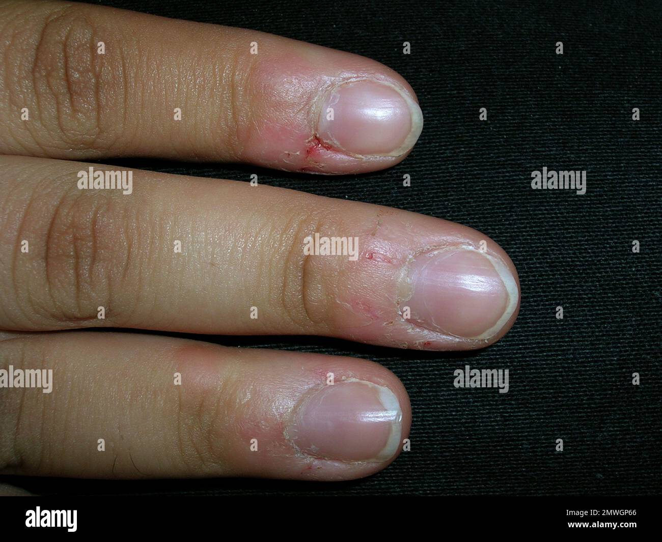 How To Stop Biting Nails: Quit Your Nail-Biting HabitHelloGiggles
