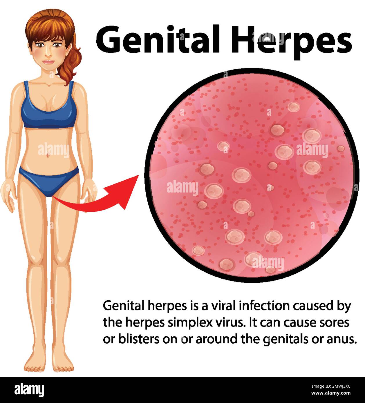 Genital Herpes infographic with explanation illustration Stock Vector
