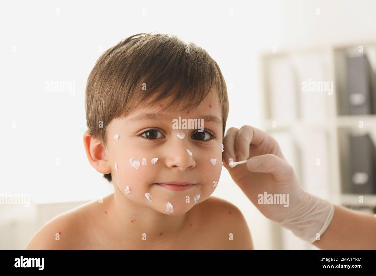 Chickenpox Doctor Doctor applying cream onto skin of little boy with chickenpox in clinic ...