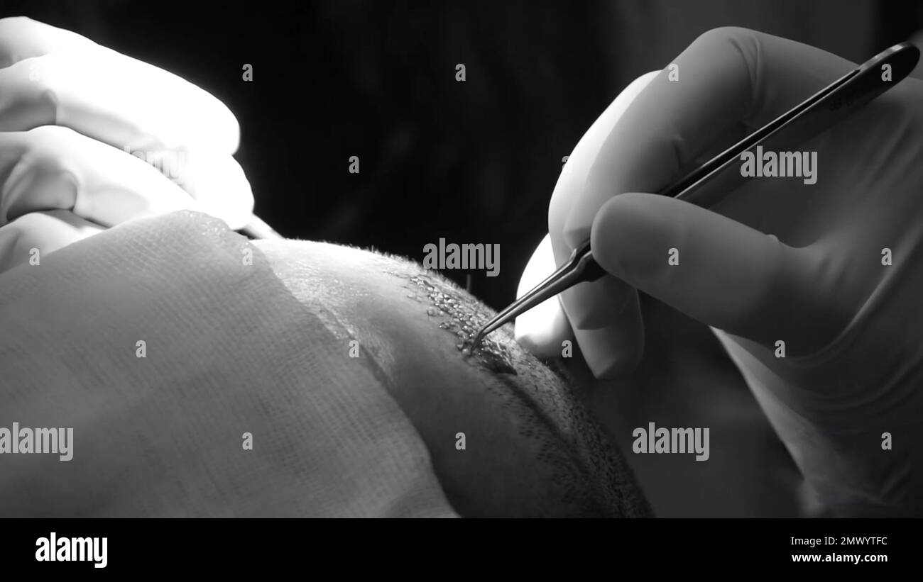 Close-up shot of hair transplantation procedure Stock Photo