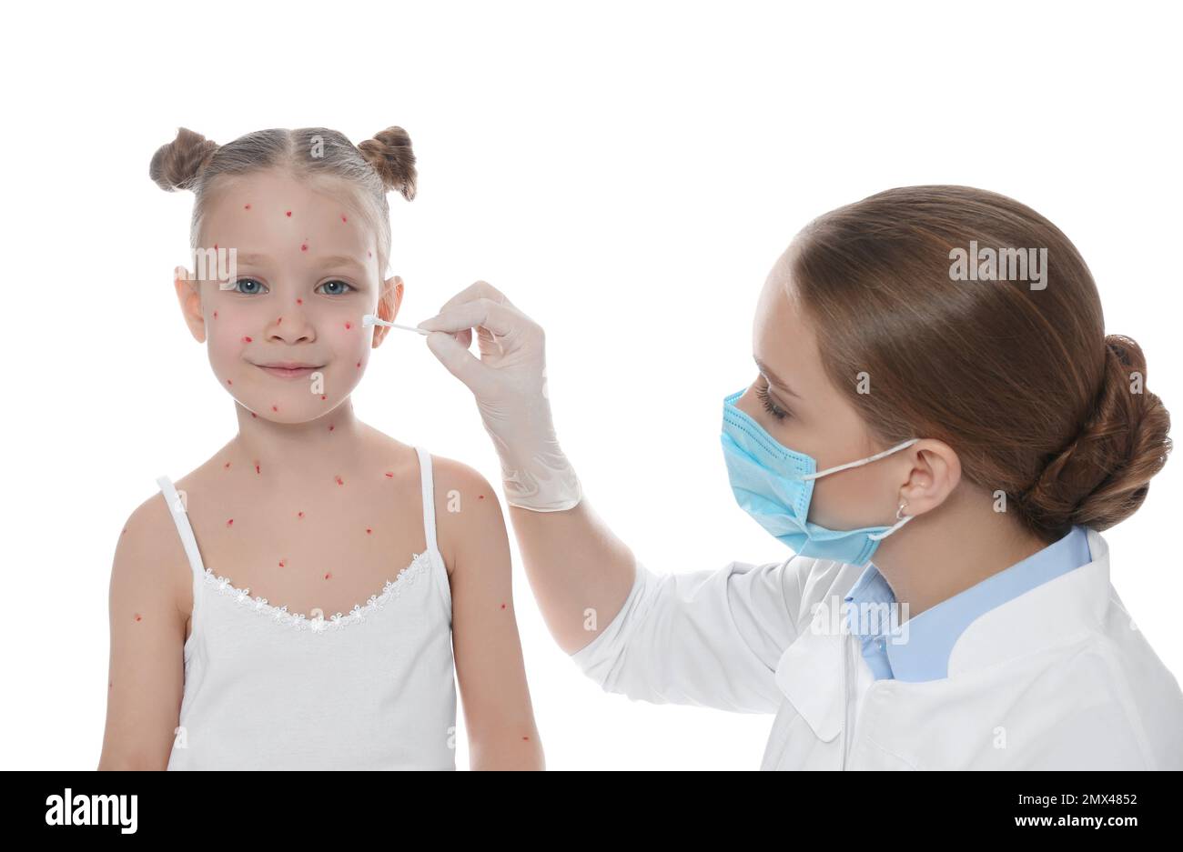Chickenpox Doctor Doctor applying cream onto skin of little girl with chickenpox against ...