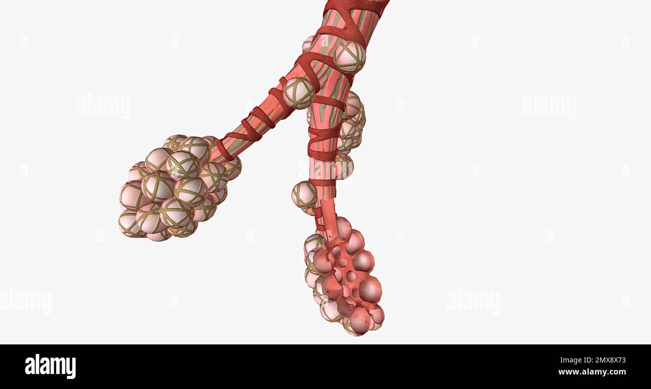 The alveoli are tiny airfilled pockets located in the lungs. 3D