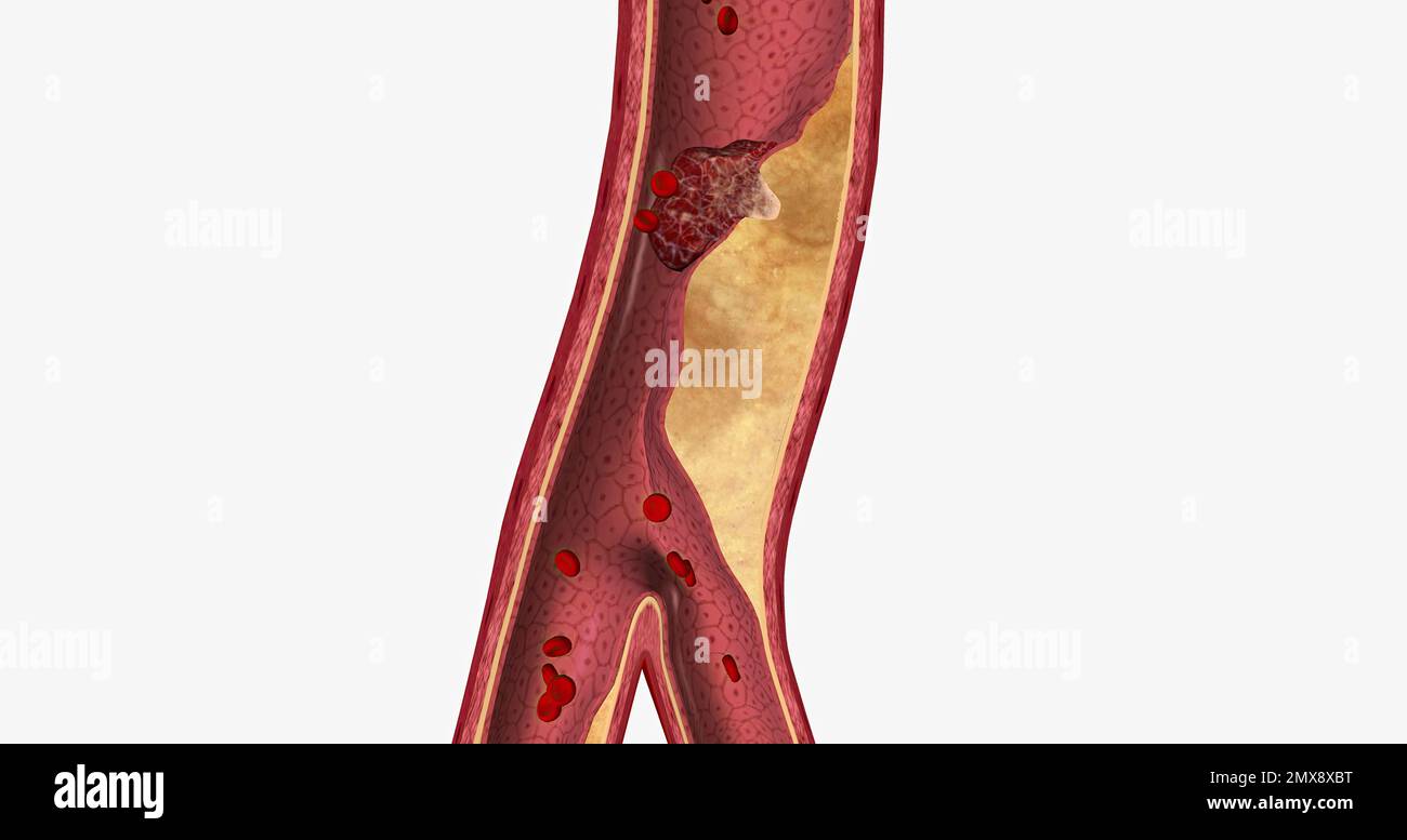 Atherosclerosis is a cardiovascular disease characterized by the