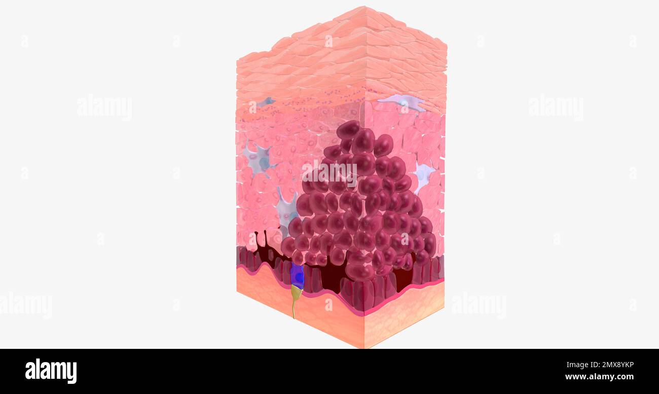 Basal Cell Carcinoma in Tissue, Stage 0 3D rendering Stock Photo Alamy
