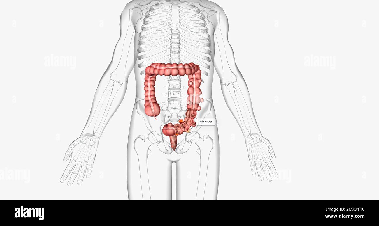 Diverticulosis occurs when small, bulging pouches develop in your